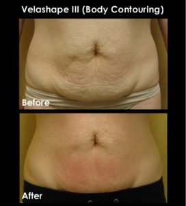 Velashape for targeted fat loss- before and after